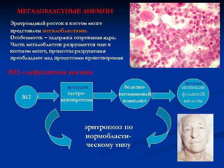 МЕГАЛОБЛАСТНЫЕ АНЕМИИ Эритроидный росток в костом мозге представлен мегалобластами. Особенность – задержка созревания ядра.