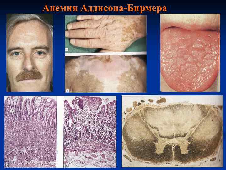 Анемия Аддисона-Бирмера 