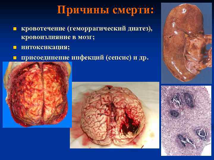 Причины смерти: n n n кровотечение (геморрагический диатез), кровоизлияние в мозг; интоксикация; присоединение инфекций