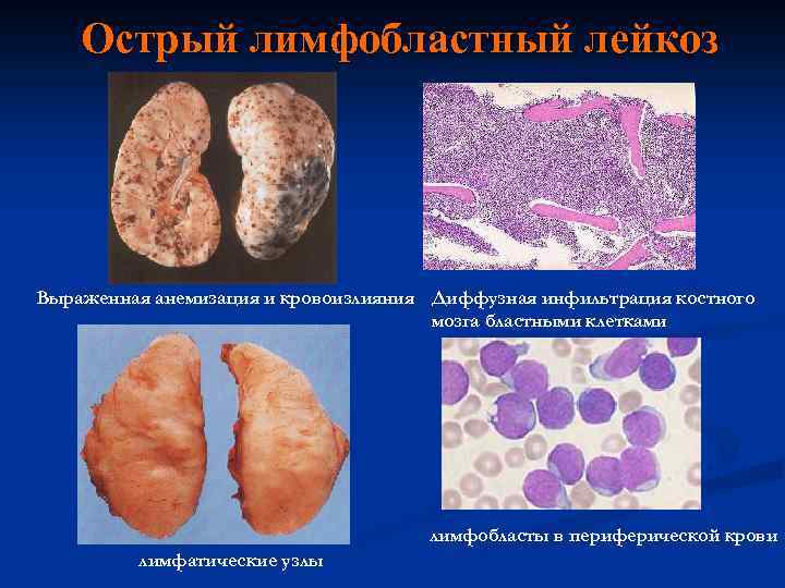 Острый лимфобластный лейкоз Выраженная анемизация и кровоизлияния Диффузная инфильтрация костного мозга бластными клетками лимфобласты
