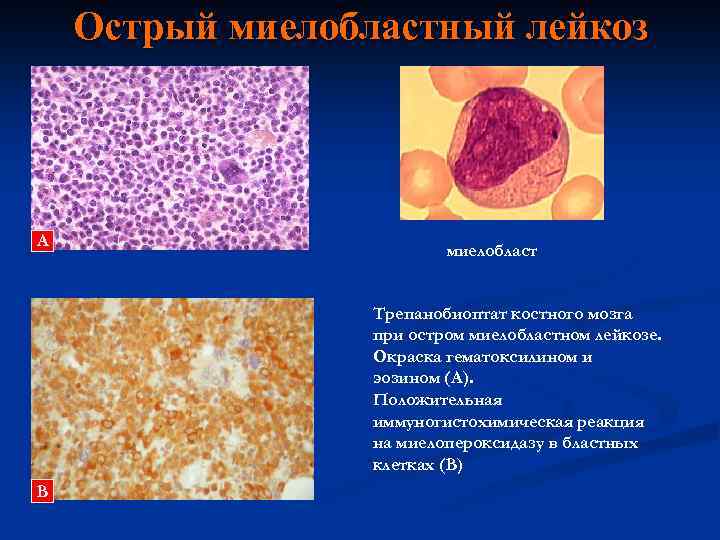 Острый миелобластный лейкоз А миелобласт Трепанобиоптат костного мозга при остром миелобластном лейкозе. Окраска гематоксилином