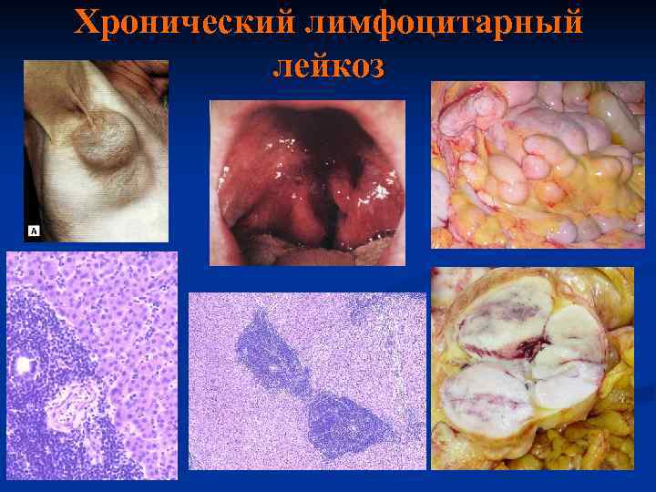 Хронический лимфоцитарный лейкоз 