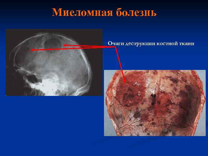 Миеломная болезнь Очаги деструкции костной ткани 