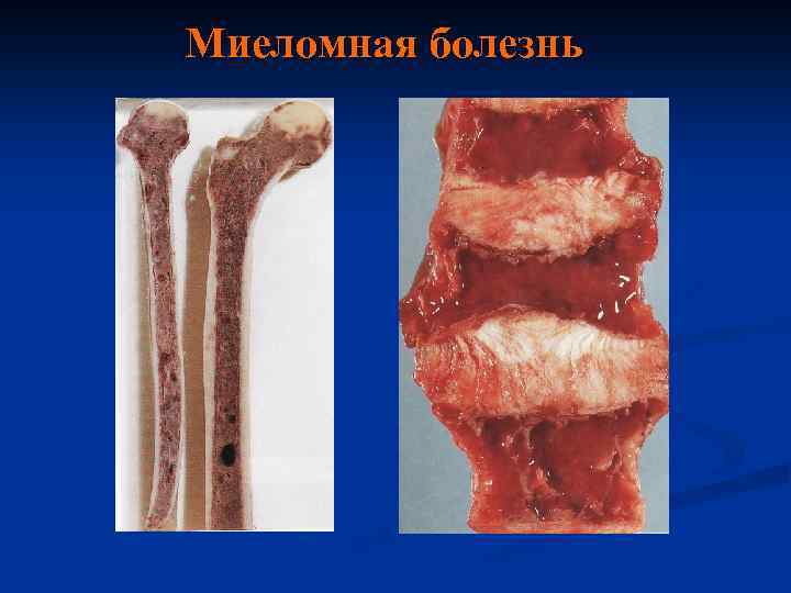 Миеломная болезнь 