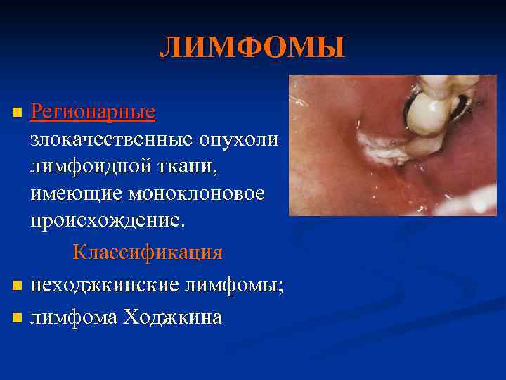 ЛИМФОМЫ Регионарные злокачественные опухоли лимфоидной ткани, имеющие моноклоновое происхождение. Классификация n неходжкинские лимфомы; n
