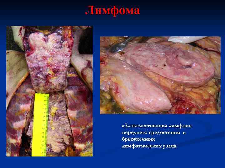 Лимфома «Злокачественная лимфома переднего средостения и брыжеечных лимфатических узлов 
