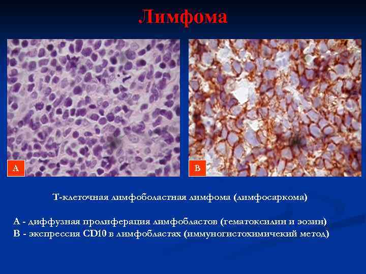 Лимфома А В Т-клеточная лимфоболастная лимфома (лимфосаркома) А - диффузная пролиферация лимфобластов (гематоксилин и