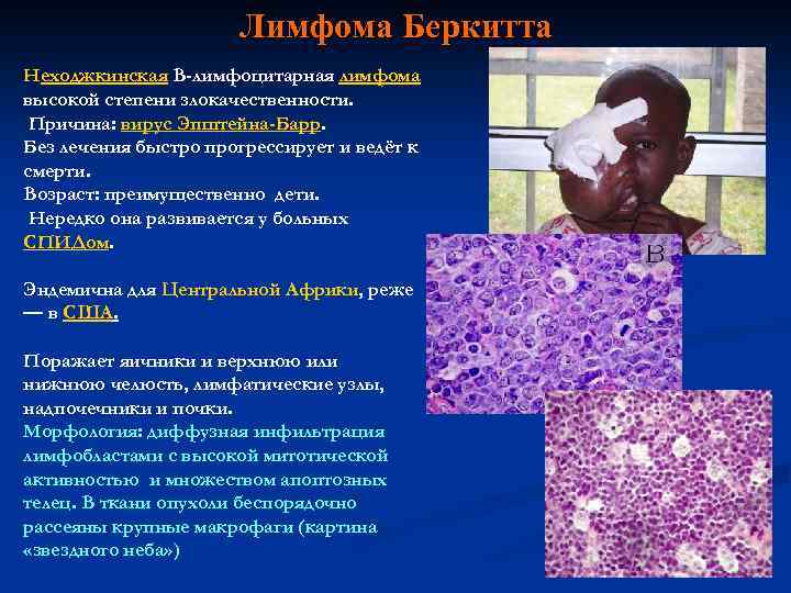Лимфома Беркитта Неходжкинская B-лимфоцитарная лимфома высокой степени злокачественности. Причина: вирус Эпштейна-Барр. Без лечения быстро
