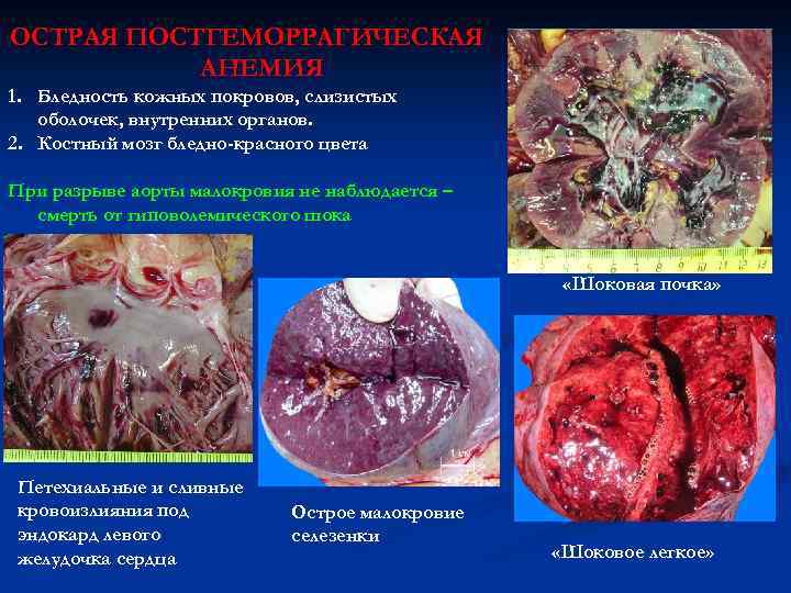 ОСТРАЯ ПОСТГЕМОРРАГИЧЕСКАЯ АНЕМИЯ 1. Бледность кожных покровов, слизистых оболочек, внутренних органов. 2. Костный мозг