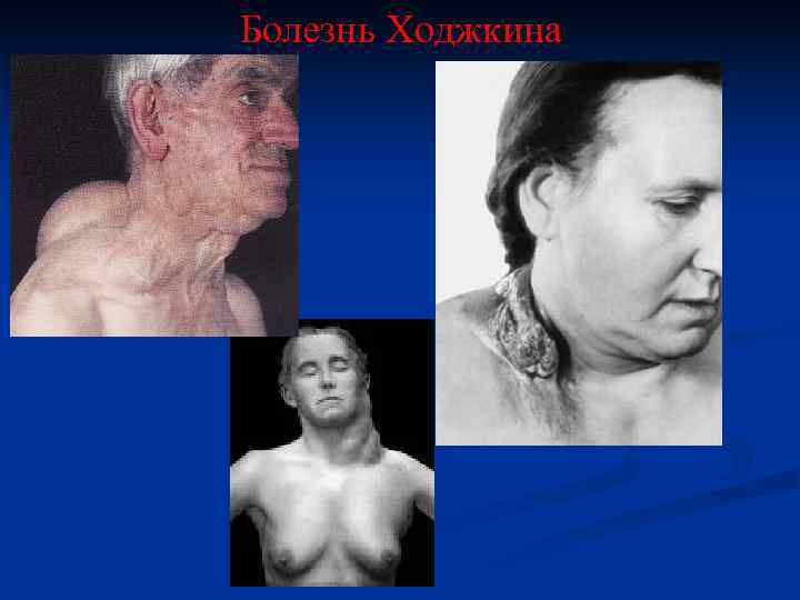 Болезнь Ходжкина 