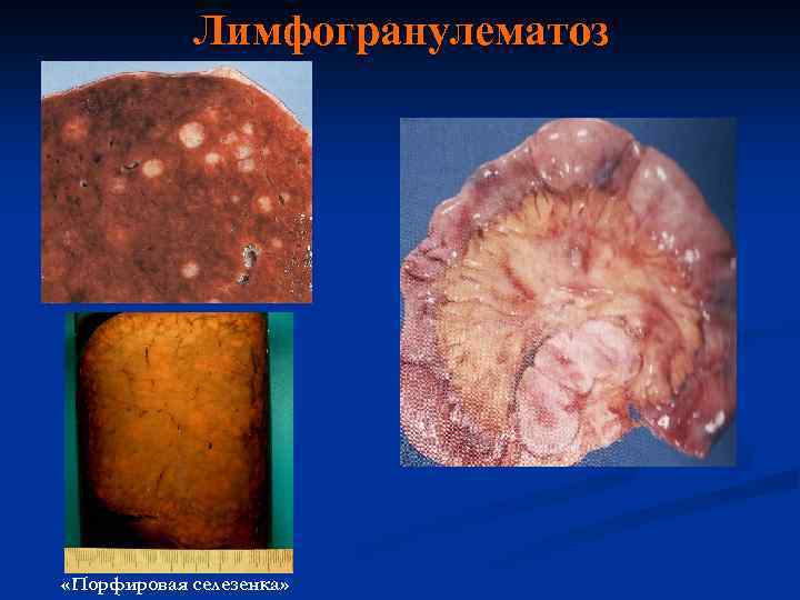 Лимфогранулематоз «Порфировая селезенка» 