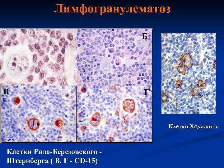 Лимфогранулематоз Клетки Ходжкина Клетки Рида-Березовского Штернберга ( В, Г - СD-15) 