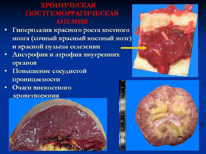  • • ХРОНИЧЕСКАЯ ПОСТГЕМОРРАГИЧЕСКАЯ АНЕМИЯ Гиперплазия красного роста костного мозга (сочный красный костный