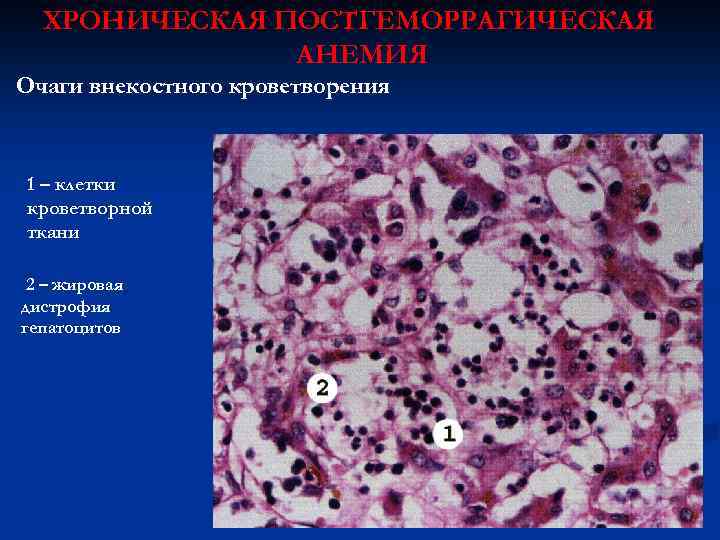 ХРОНИЧЕСКАЯ ПОСТГЕМОРРАГИЧЕСКАЯ АНЕМИЯ Очаги внекостного кроветворения 1 – клетки кроветворной ткани 2 – жировая