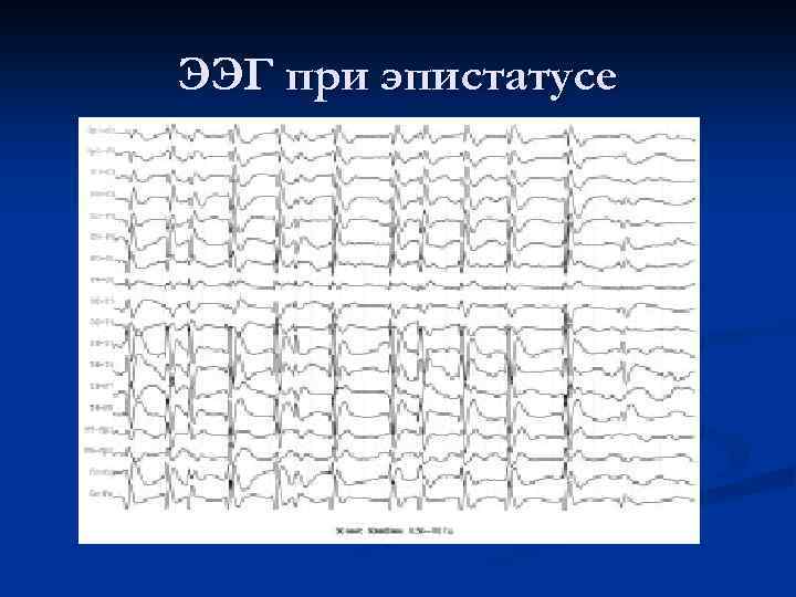 ЭЭГ при эпистатусе 