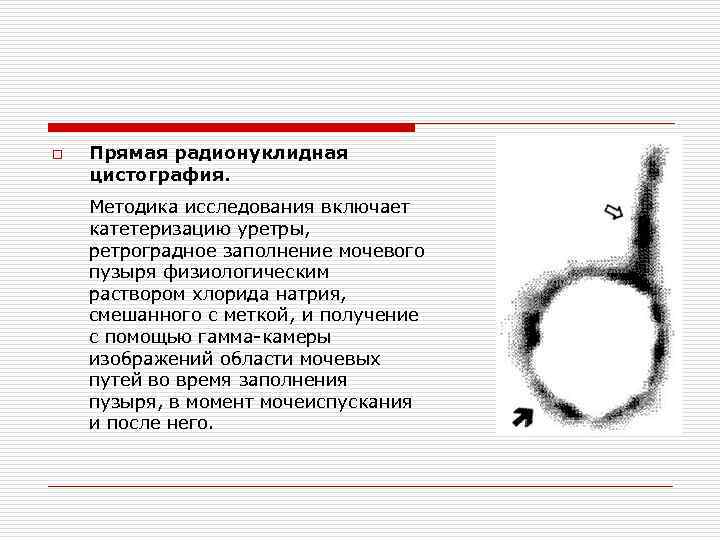 o Прямая радионуклидная цистография. Методика исследования включает катетеризацию уретры, ретроградное заполнение мочевого пузыря физиологическим o Прямая радионуклидная цистография. Методика исследования включает катетеризацию уретры, ретроградное заполнение мочевого пузыря физиологическим