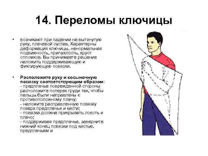 14. Переломы ключицы • возникают при падении на вытянутую руку, плечевой сустав. Характерны деформация