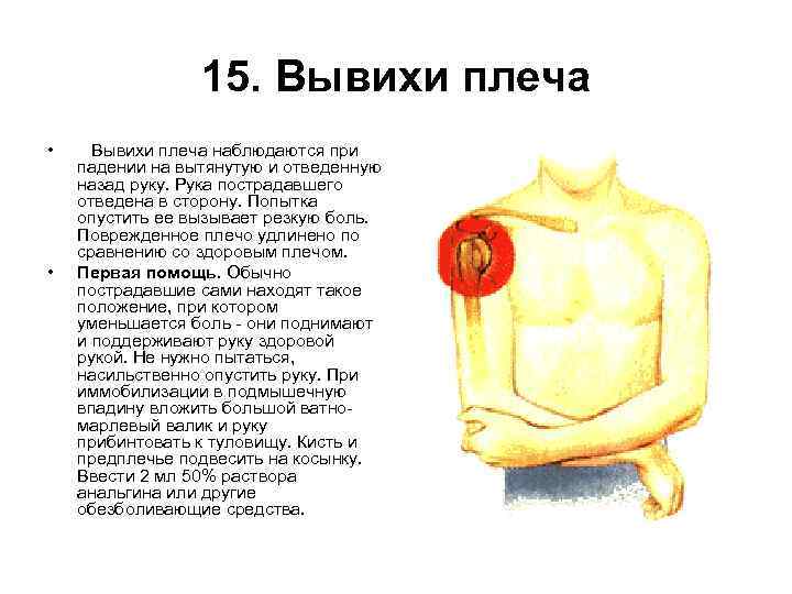 15. Вывихи плеча • • Вывихи плеча наблюдаются при падении на вытянутую и отведенную