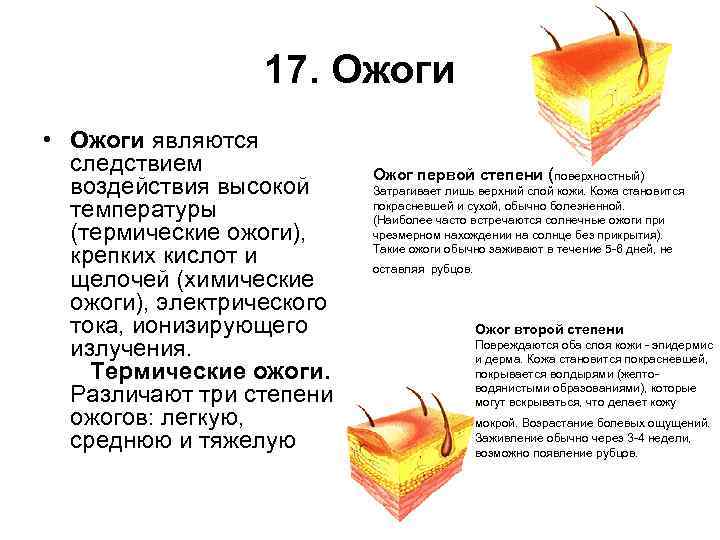 17. Ожоги • Ожоги являются следствием воздействия высокой температуры (термические ожоги), крепких кислот и