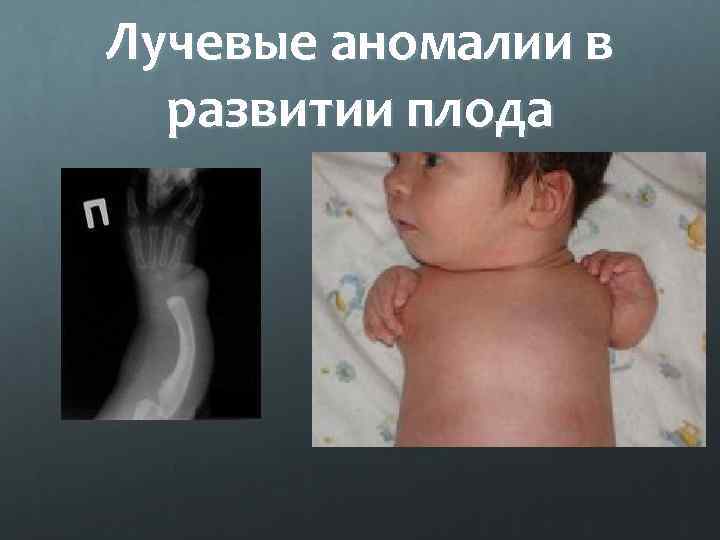Лучевые аномалии в развитии плода 