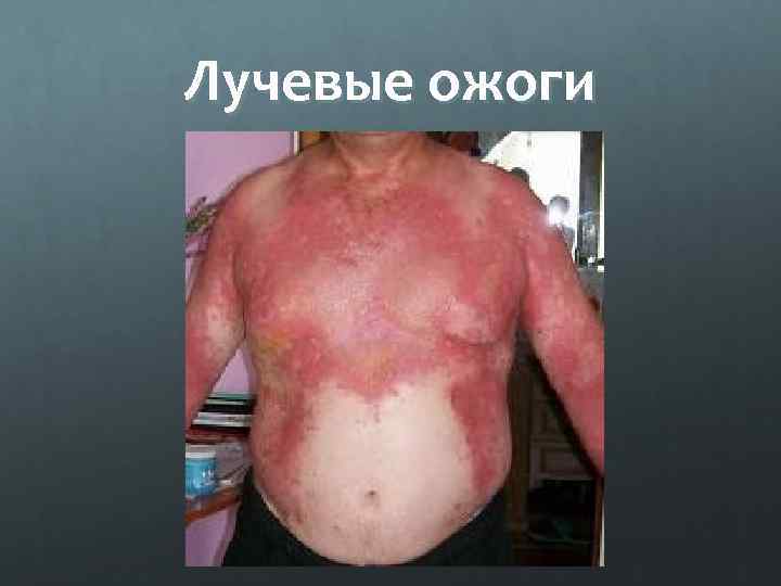 Лучевые ожоги 