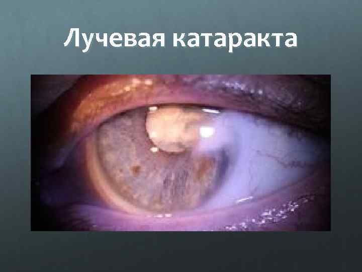 Лучевая катаракта 