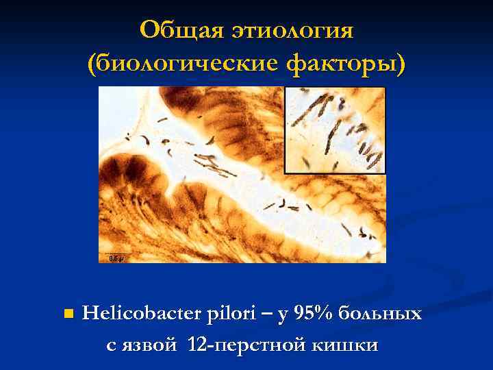 Общая этиология (биологические факторы) n Helicobacter pilori – у 95% больных с язвой 12