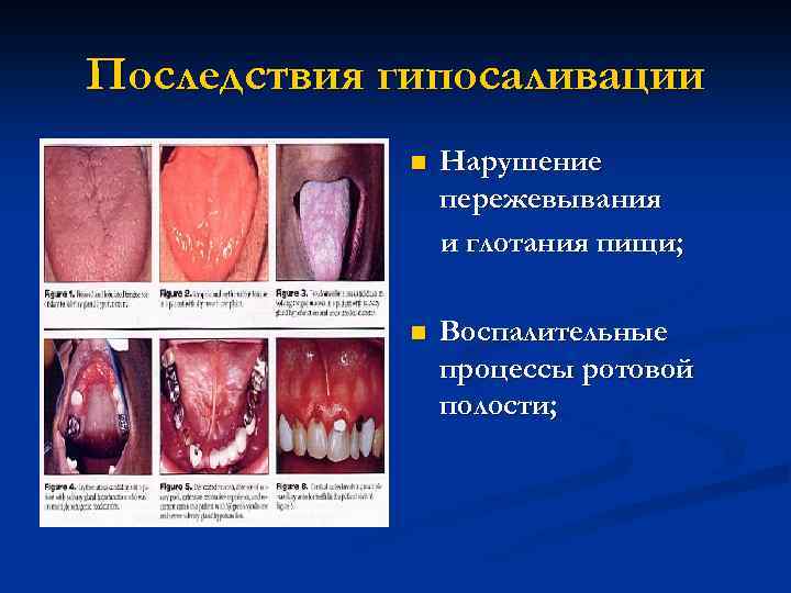 Последствия гипосаливации n Нарушение пережевывания и глотания пищи; n Воспалительные процессы ротовой полости; 