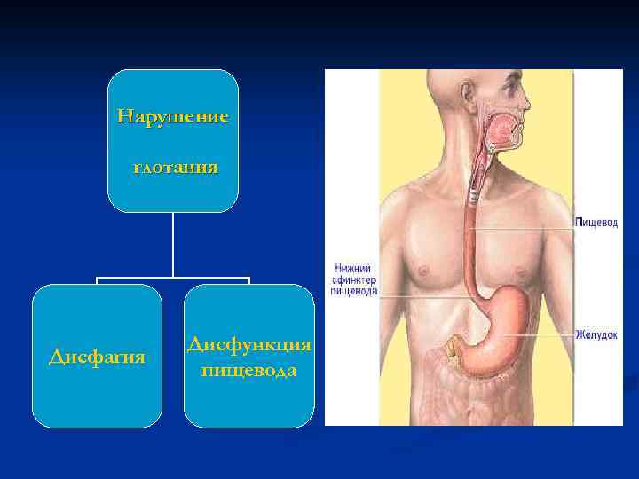 Дисфагия пищевода. Эзофагеальная дисфункция. Патологическая дисфагия.