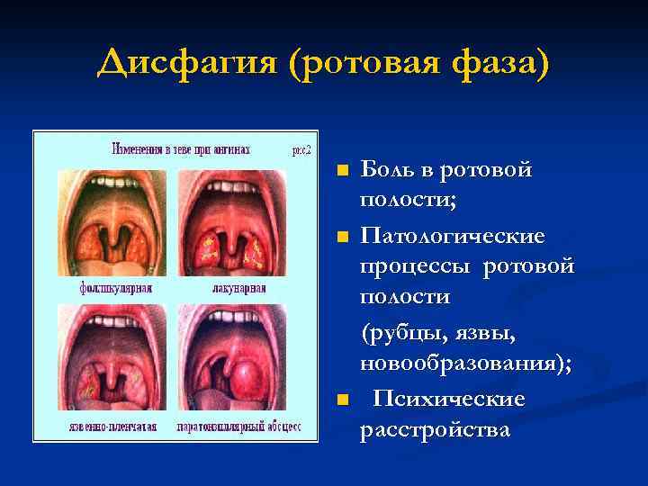 Дисфагия (ротовая фаза) n n n Боль в ротовой полости; Патологические процессы ротовой полости