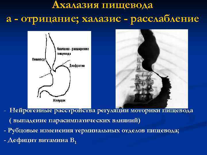 Ахалазия пищевода а - отрицание; халазис - расслабление - Нейрогенные расстройства регуляции моторики пищевода