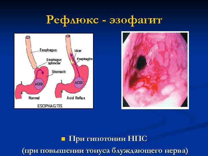 Рефлюкс - эзофагит При гипотонии НПС (при повышении тонуса блуждающего нерва) n 