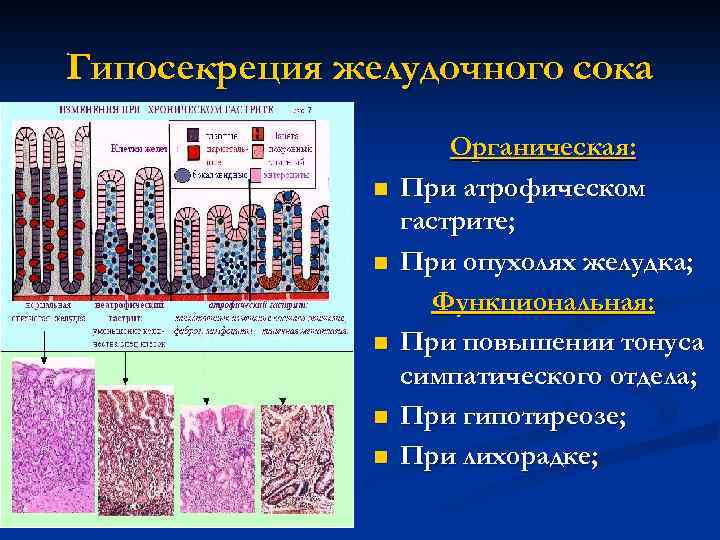 Гипосекреция желудочного сока n n n Органическая: При атрофическом гастрите; При опухолях желудка; Функциональная: