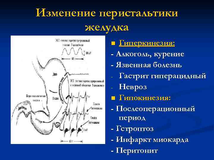 Изменение перистальтики желудка Гиперкинезия: - Алкоголь, курение - Язвенная болезнь - Гастрит гиперацидный -