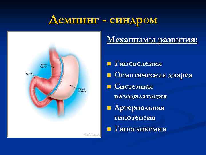 Демпинг синдром. Демпинг синдром механизм. Демпинг синдром гиповолемия. Демпинг синдром гипогликемия. Синдром артериальной вазодилатации.