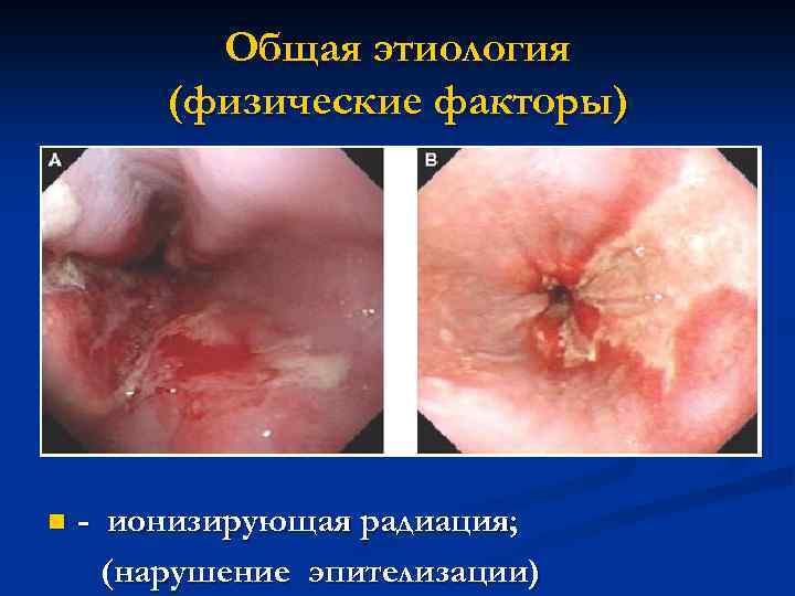 Общая этиология (физические факторы) n - ионизирующая радиация; (нарушение эпителизации) 