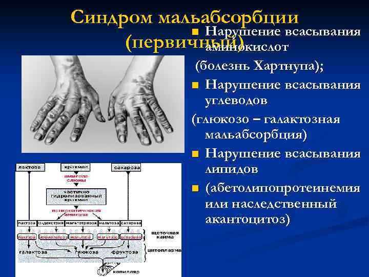 Нарушение мальабсорбции