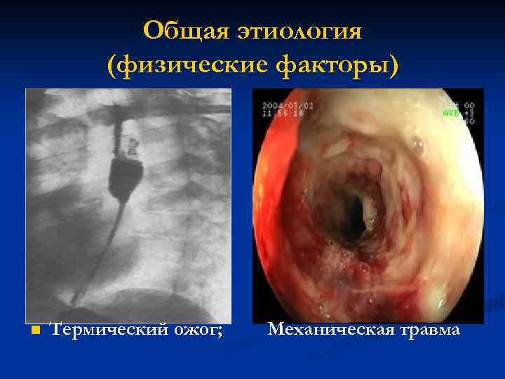 Общая этиология (физические факторы) n Термический ожог; Механическая травма 