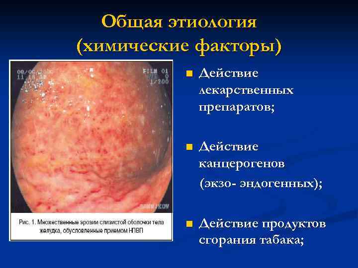 Общая этиология (химические факторы) n Действие лекарственных препаратов; n Действие канцерогенов (экзо- эндогенных); n