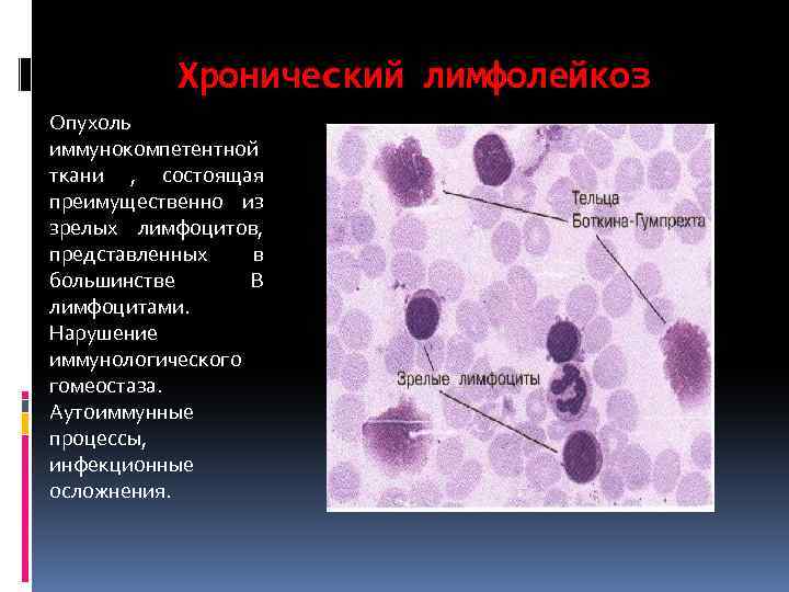 Хронический лимфолейкоз Опухоль иммунокомпетентной ткани , состоящая преимущественно из зрелых лимфоцитов, представленных в большинстве
