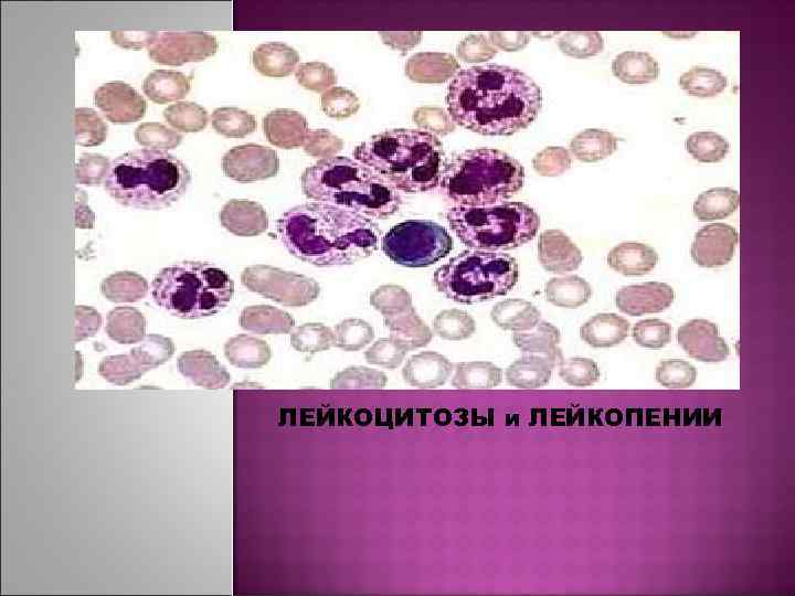 Лейкоцитоз и лейкопения. Лейкоцитозы, лейкозы и лейкопении.. Картина крови при лейкопении. Лейкоцитоз и лейкопения под микроскопом.