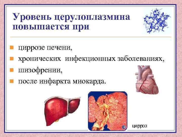 Уровень церулоплазмина повышается при n n циррозе печени, хронических инфекционных заболеваниях, шизофрении, после инфаркта