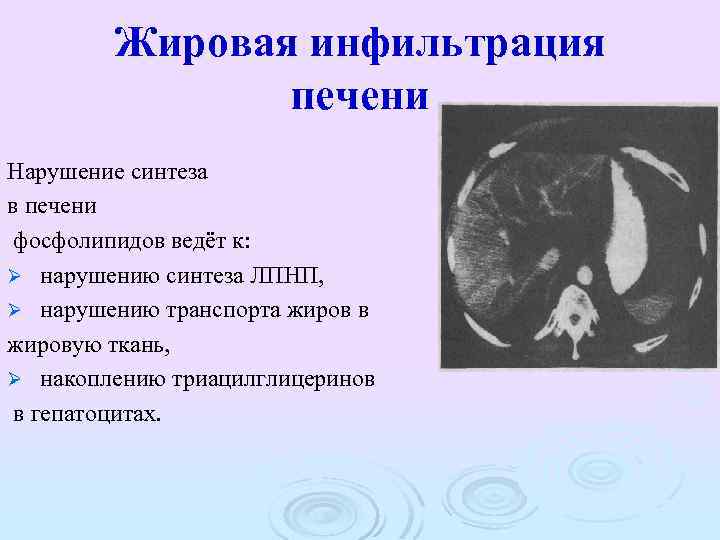 Жировая инфильтрация печени Нарушение синтеза в печени фосфолипидов ведёт к: Ø нарушению синтеза ЛПНП,