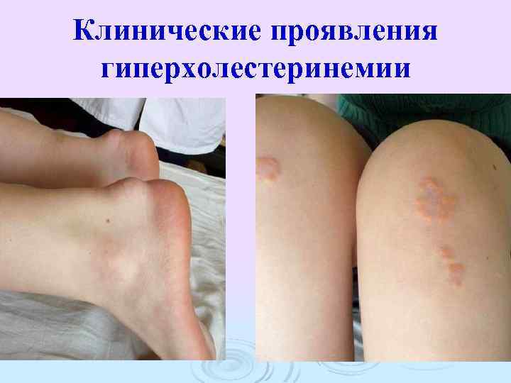 Клинические проявления гиперхолестеринемии 