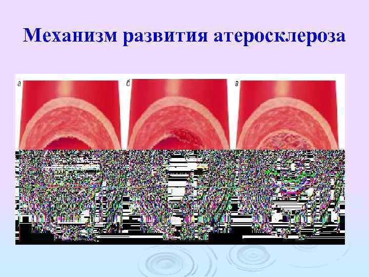 Механизм развития атеросклероза 
