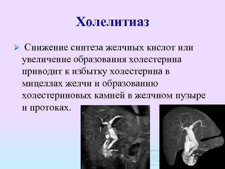 Холелитиаз Ø Снижение синтеза желчных кислот или увеличение образования холестерина приводит к избытку холестерина