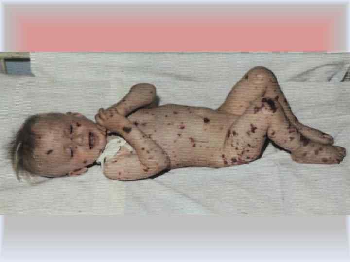  • Типичные геморрагические элементы различной величины имеют неправильные очертания звёздчатого характера, плотные на