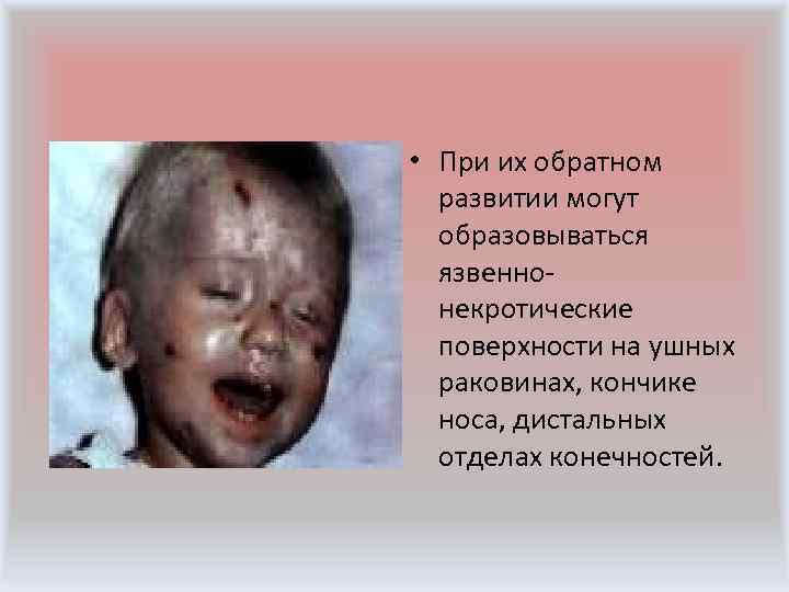  • Геморрагический синдром при менингококцемии проявляется кровоизлияниями на конъюнктивах, склерах и слизистой оболочке