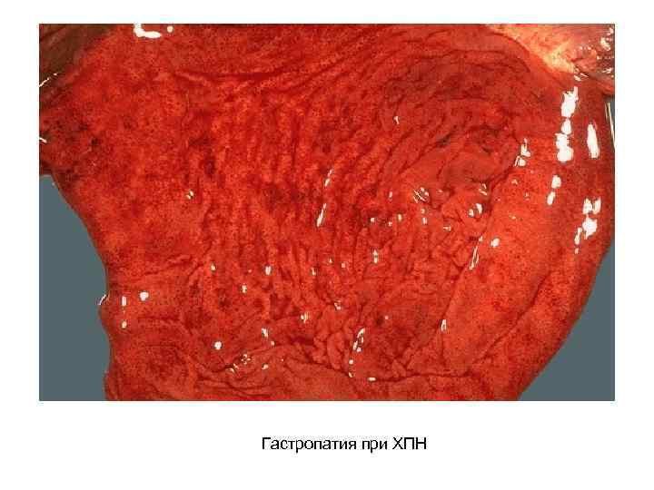 Гастропатия при ХПН 