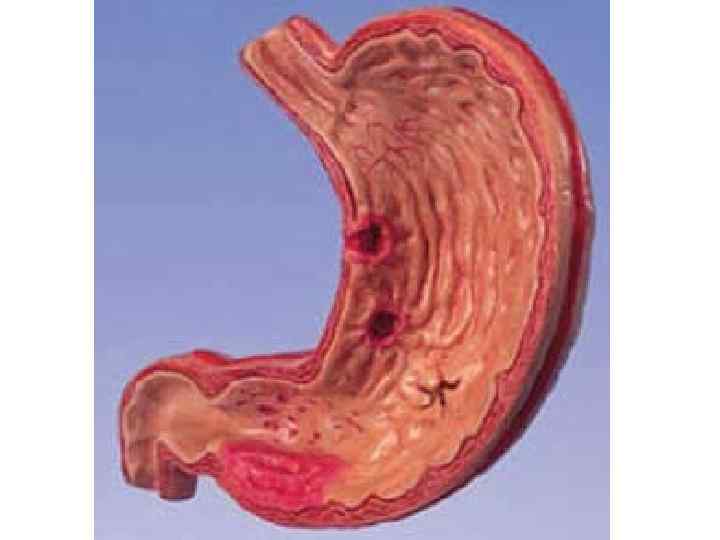 Схемы ИПП — кларитромицин — метронидазол (ИКМ) и 1 а А ИПП — кларитромицин